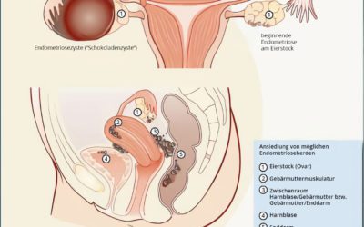 Kinderwunsch bei Endometriose