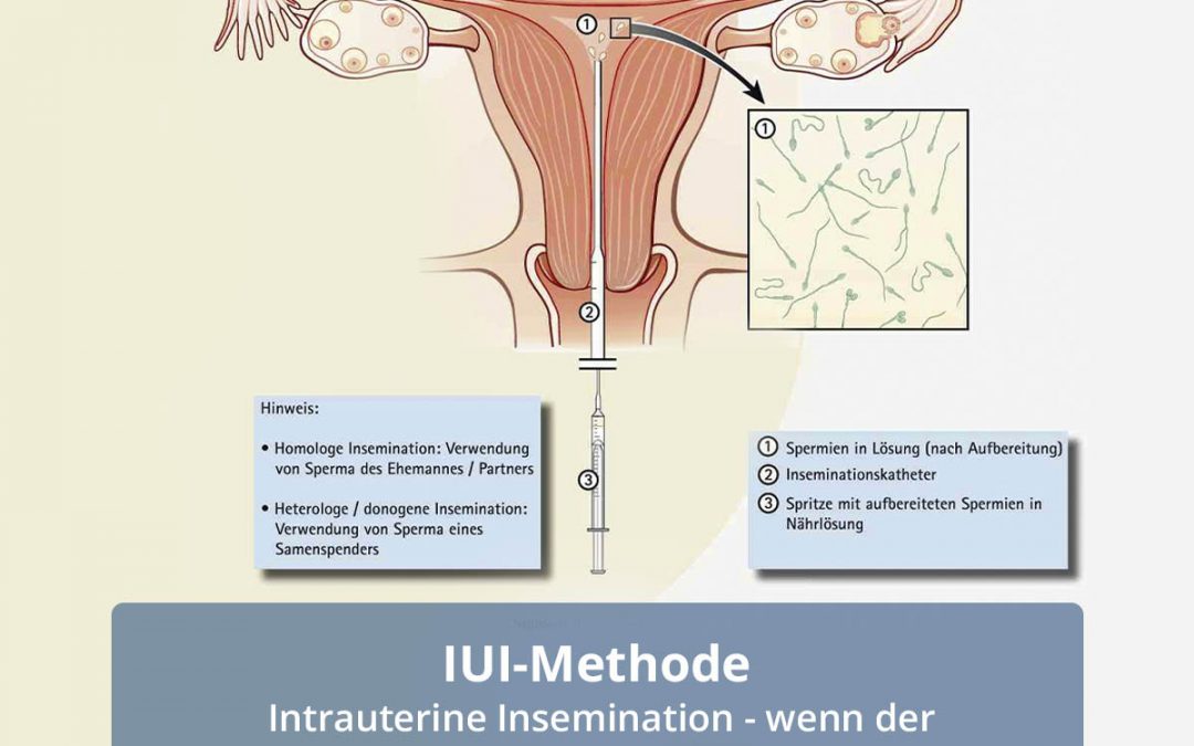 IUI – Intrauterine Insemination