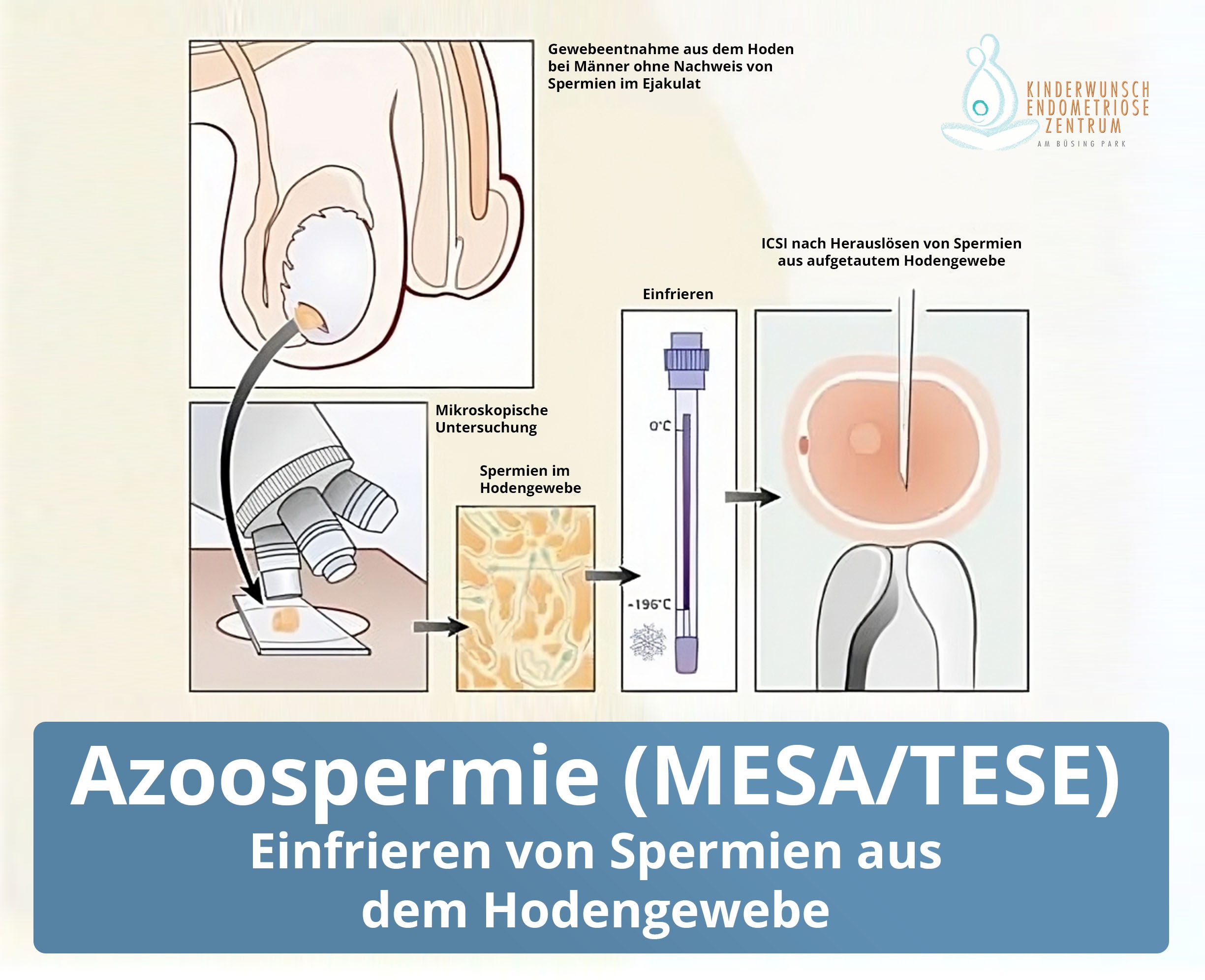 Azoospermie (MESA/TESE) Kinderwunschzentrum Offenbach