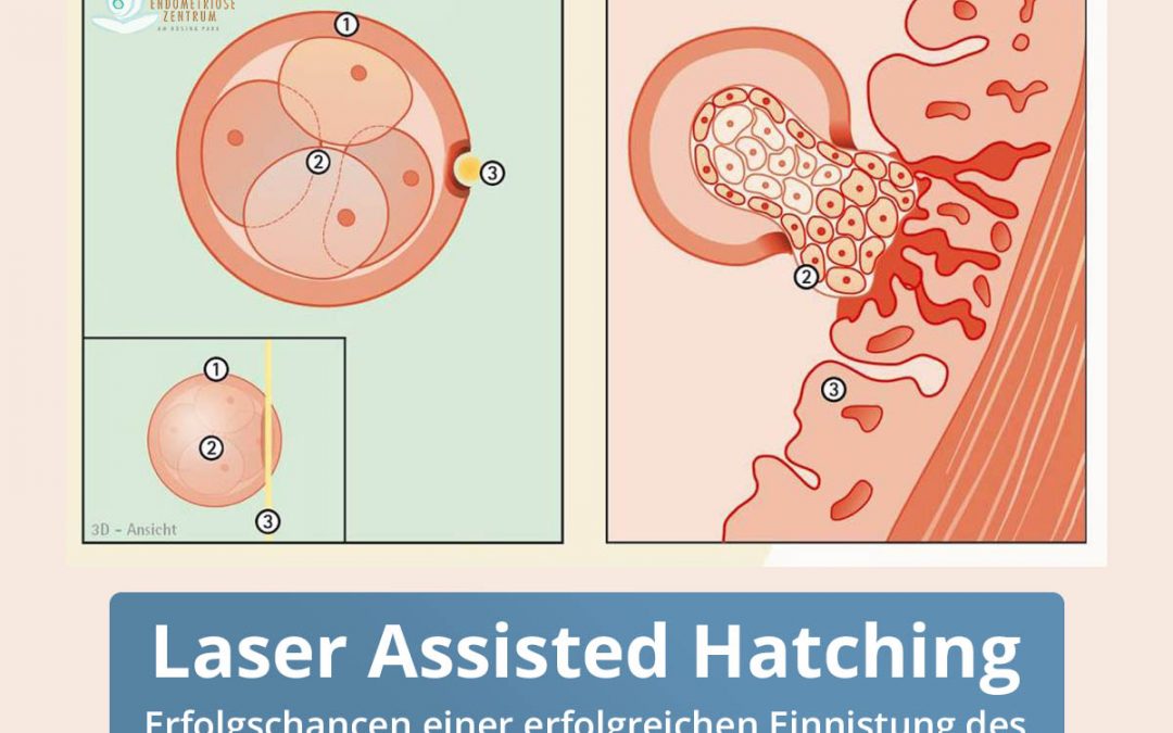 Laser Assisted Hatching – Schlüpfhilfe