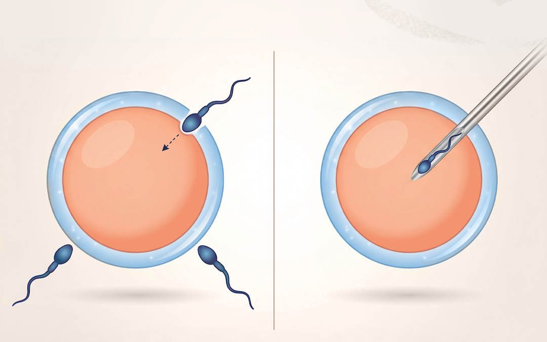 IVF oder ICSI?